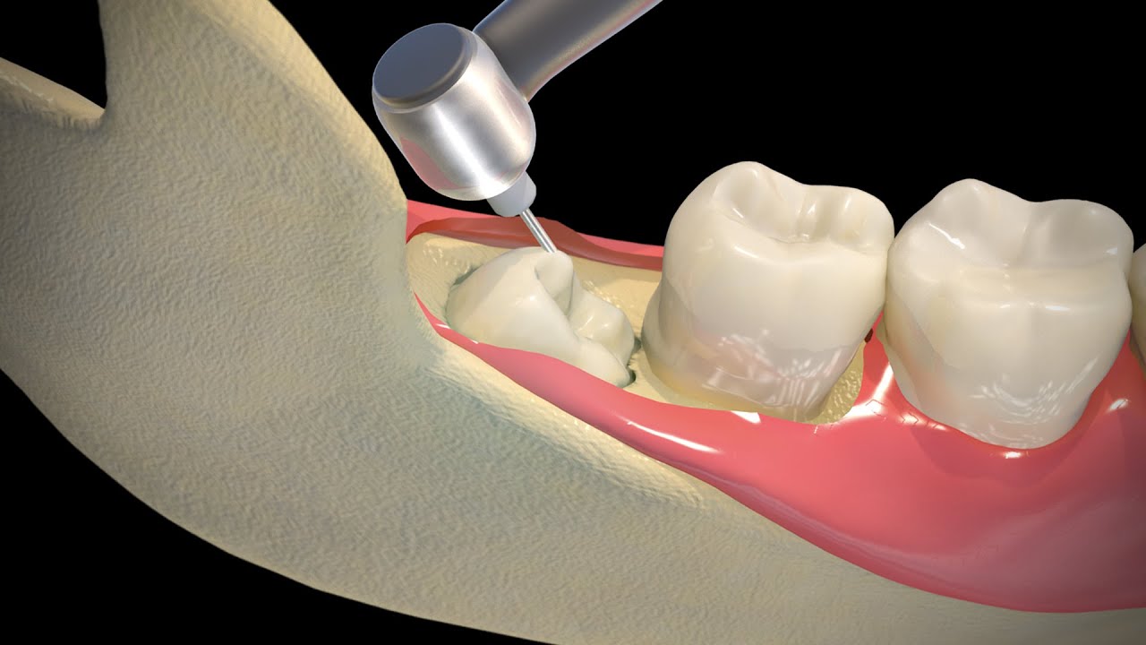 Dental Implants